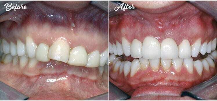 Four crowns crown lengthening before and after