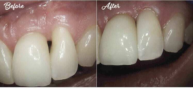 Before and after black triangle closure