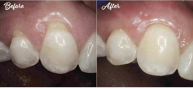 Connective Tissue Graft before and after