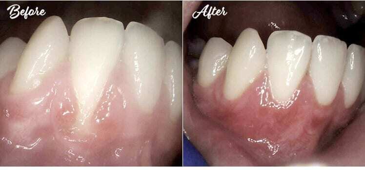 Gum graft before and after