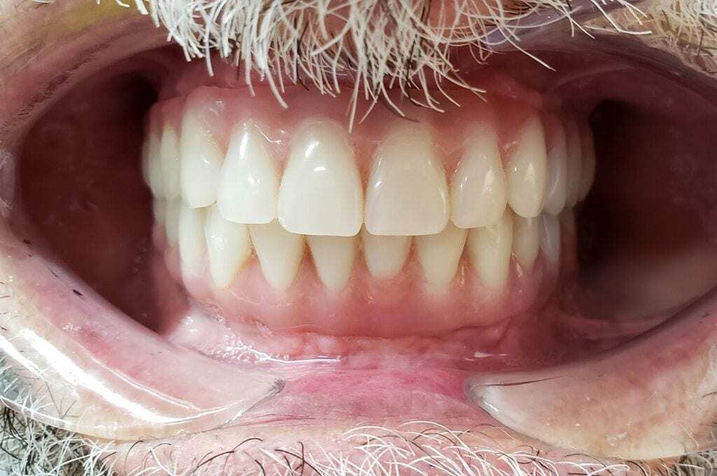full_mouth_restoration_implants_after