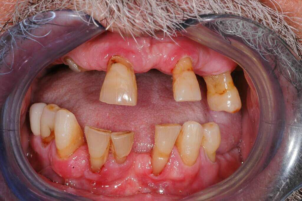 full_mouth_restoration_implants_before