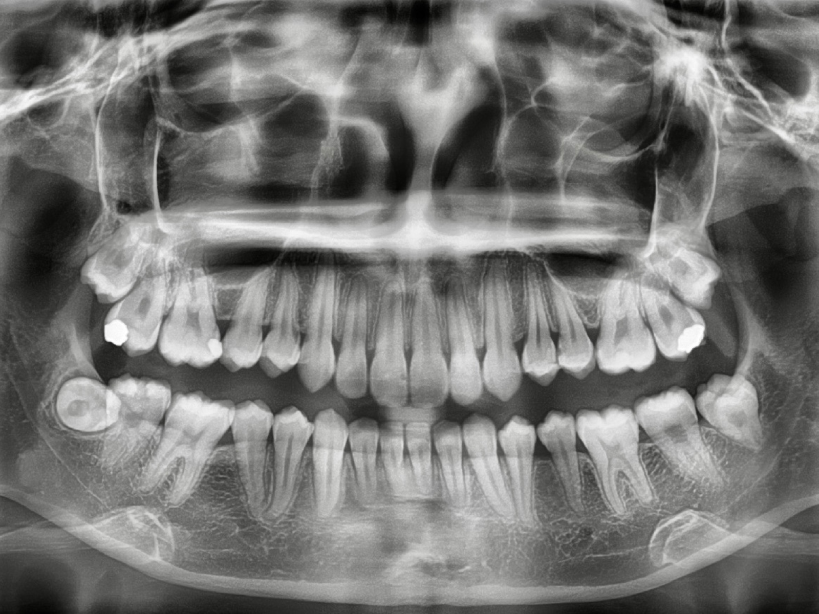Dental Xrays