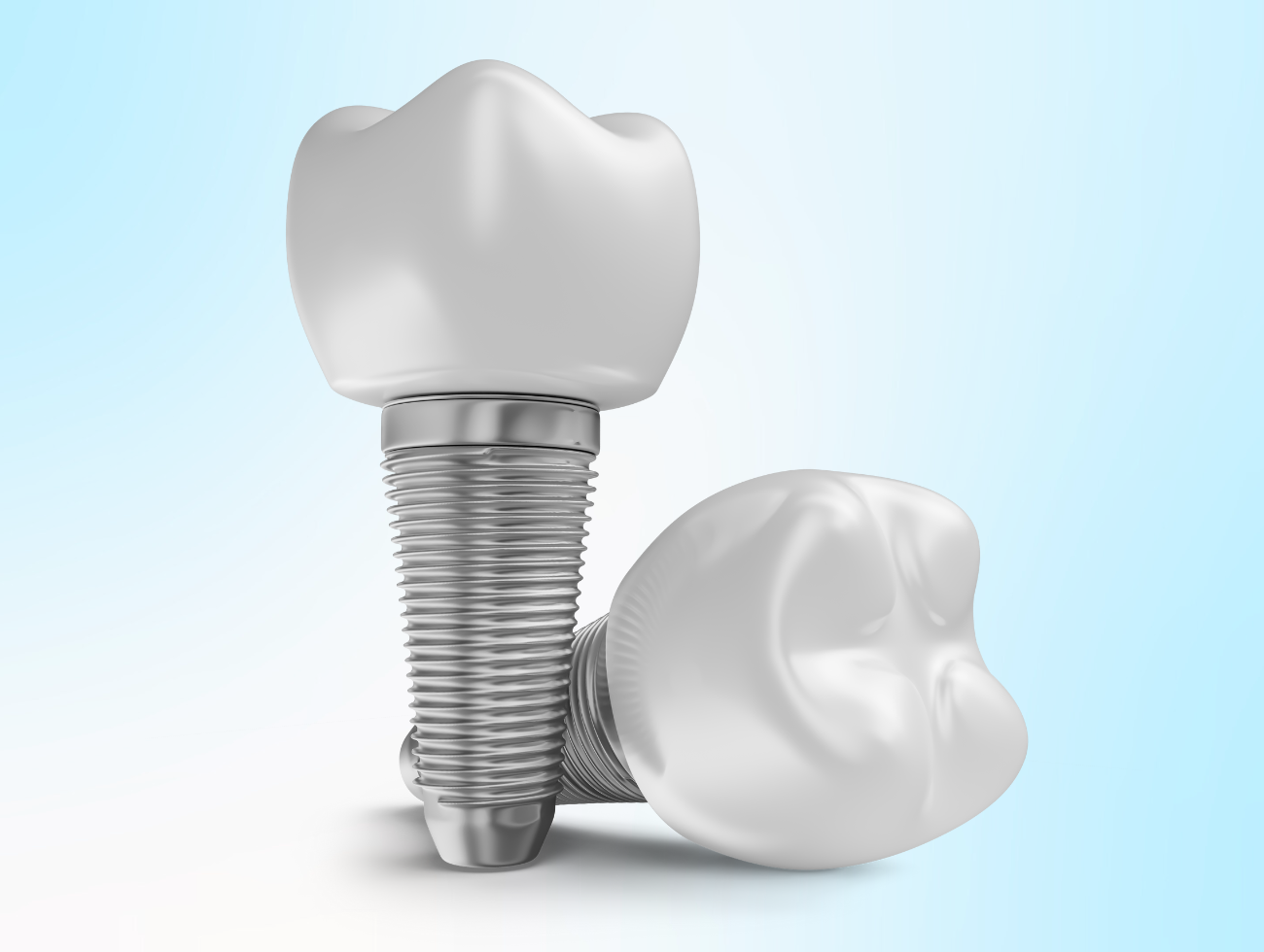 dental implants