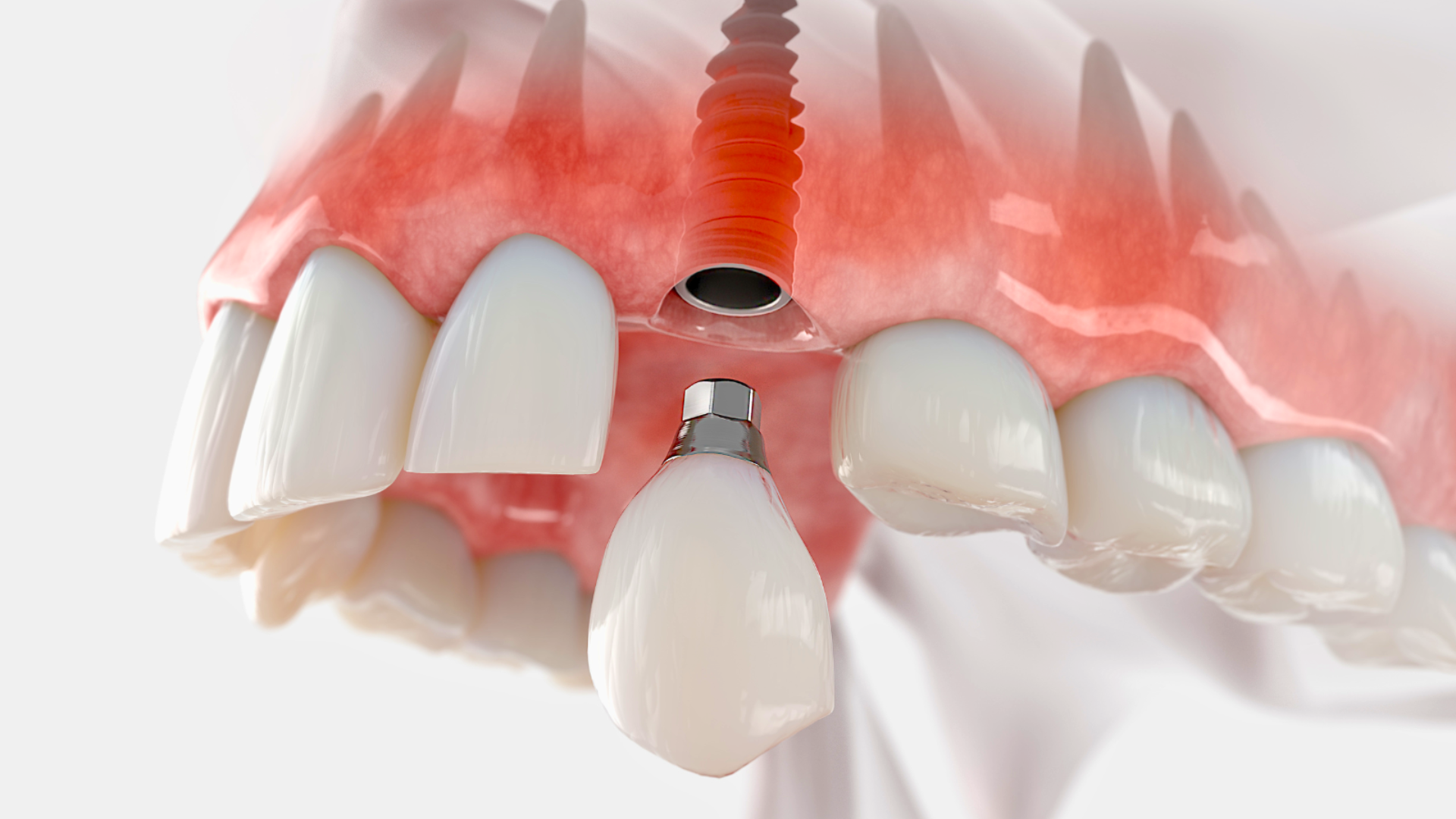 single dental implants