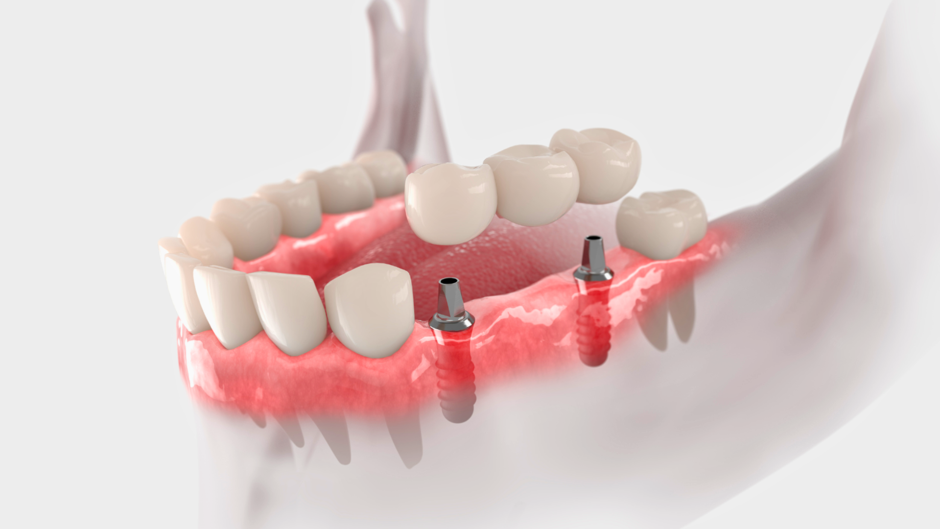multiple dental implants