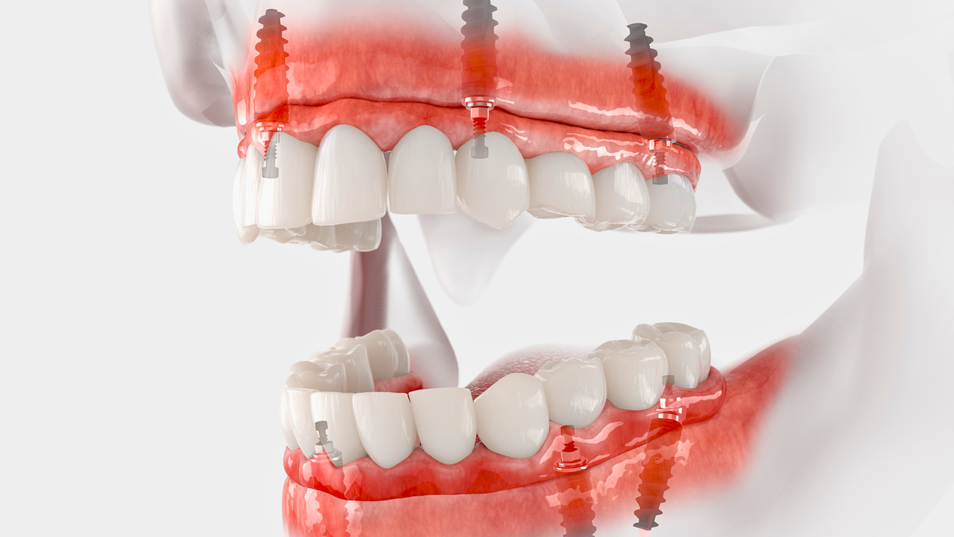 full mouth dental implants