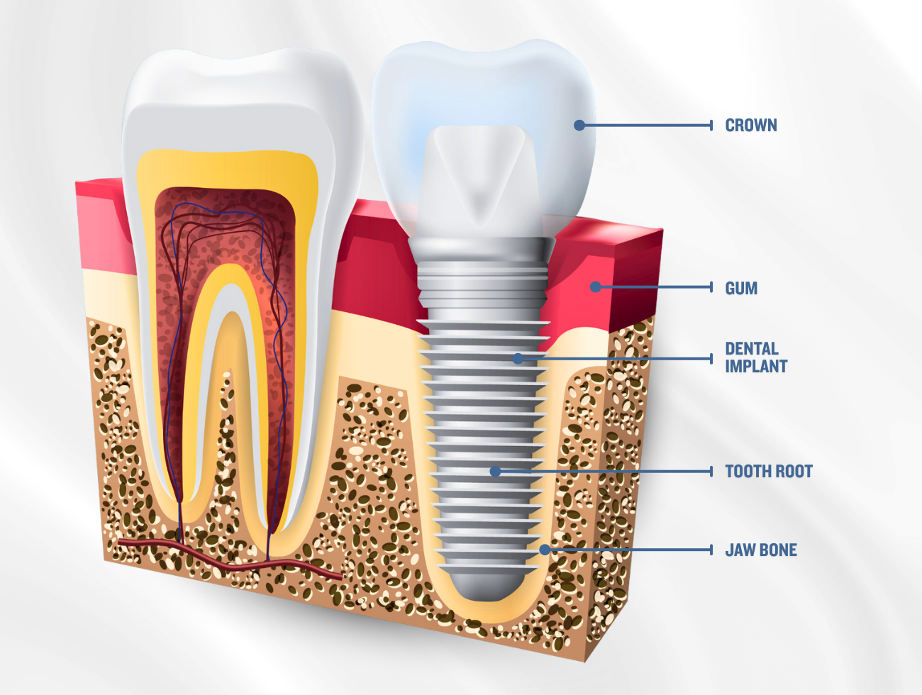 dental implant