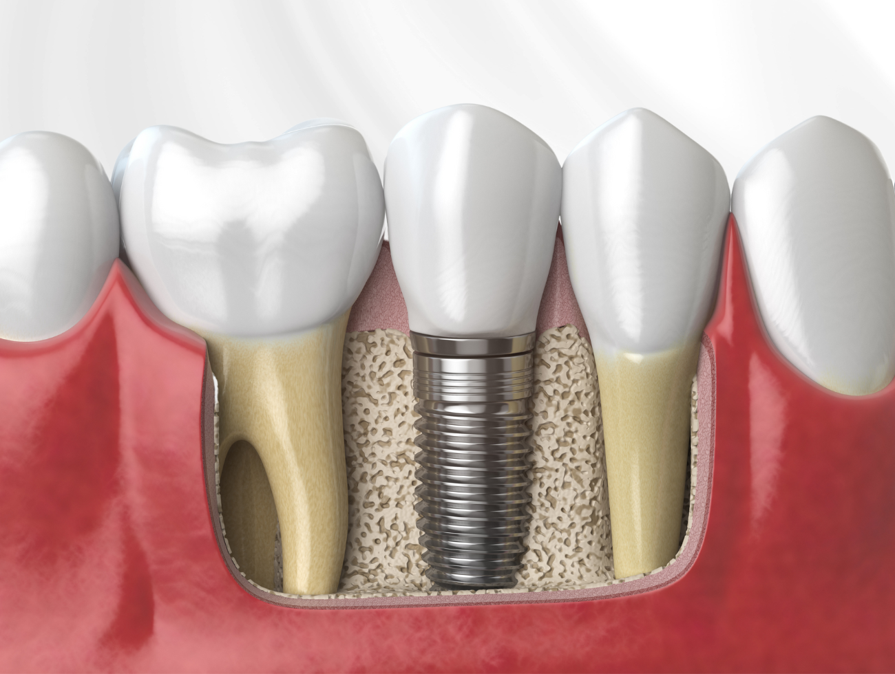 dental implant