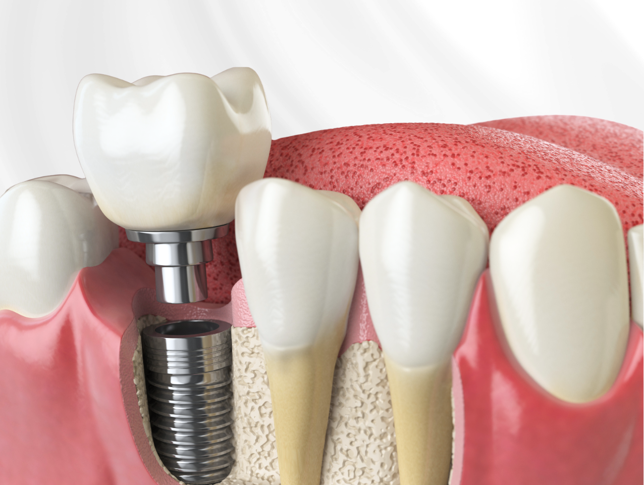 dental implant