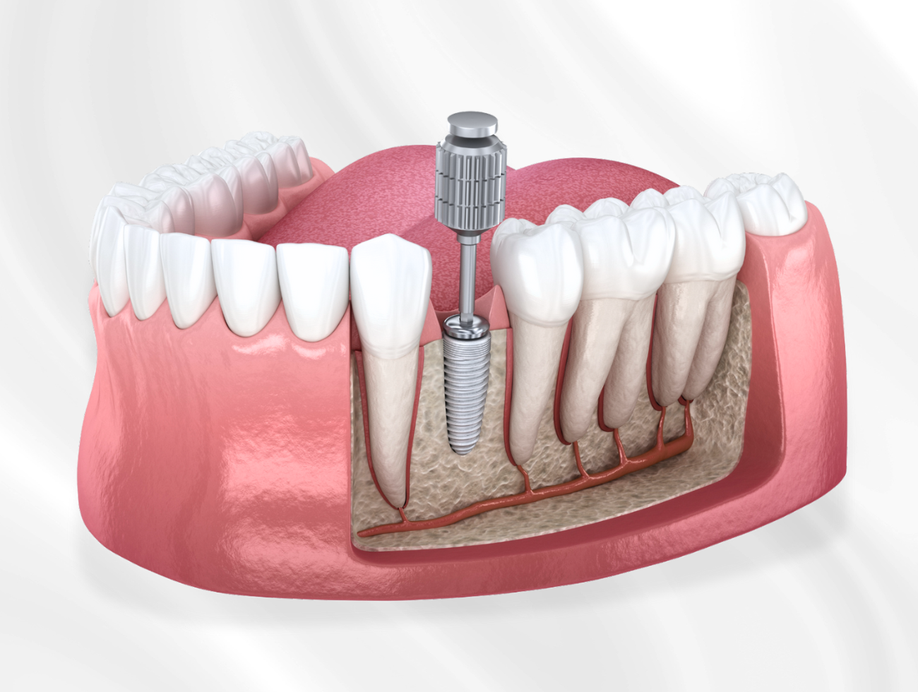 dental implant