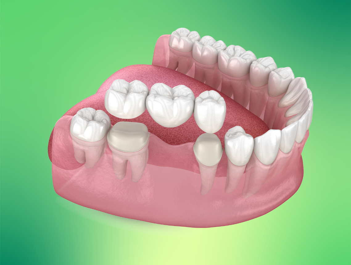 Dental Bridges Explained: A Complete Guide — Kiwi Dental - Dentist Oakville